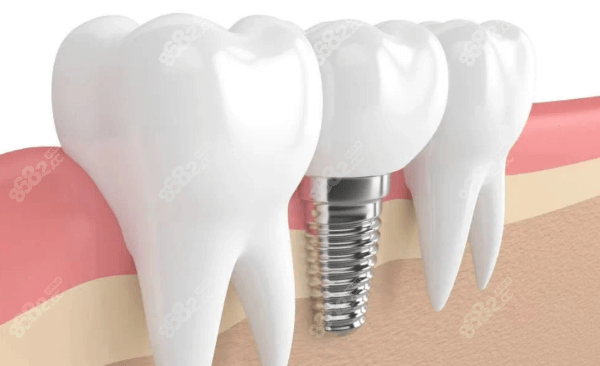 重庆牙博士口腔医院种植牙收费标准