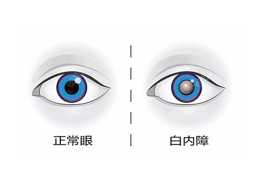 白内障和正常眼睛对比图