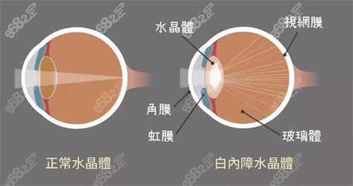 正常眼对比白内障区别