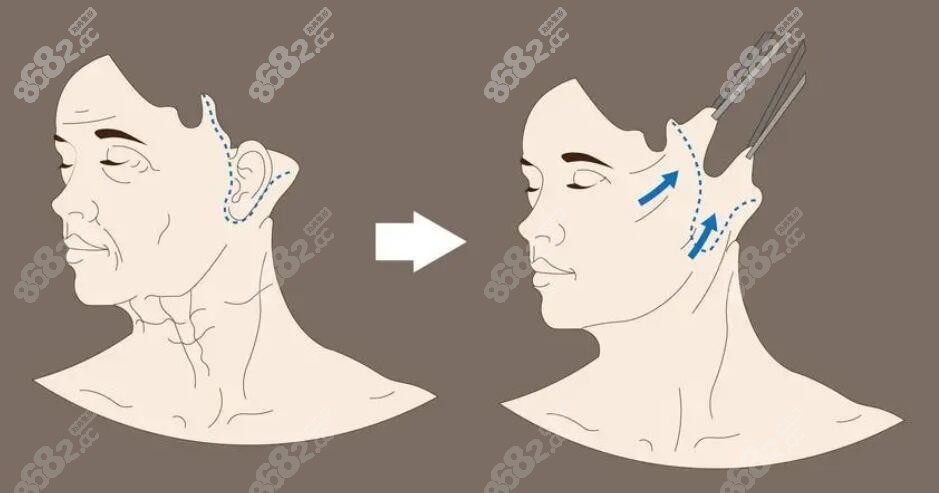 面部提升卡通图8682.cc
