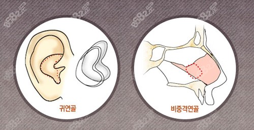 韩国赫拉整形鼻整形使用软骨