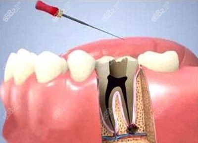 牙齿根管治疗动画图