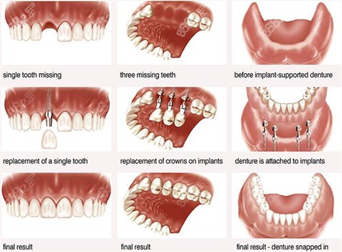 牙缺失可通过种植牙进行修复