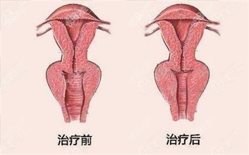 女性阴道紧缩手术前后对比动画图.png