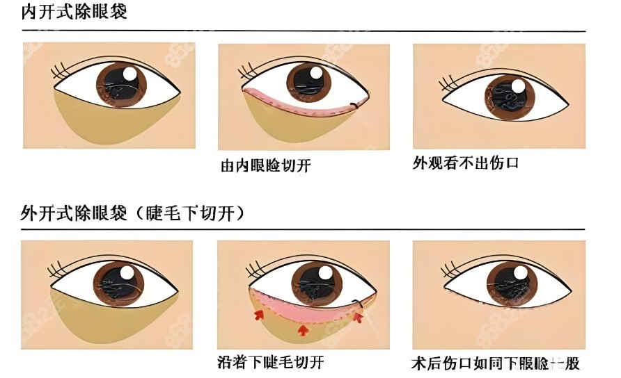 北京大学深圳医院做眼袋手术多少钱？