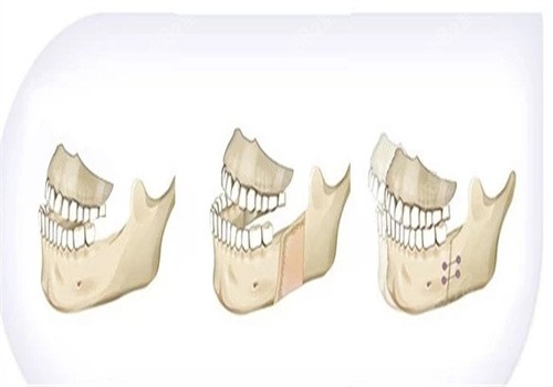 颏成型手术和正颌区别