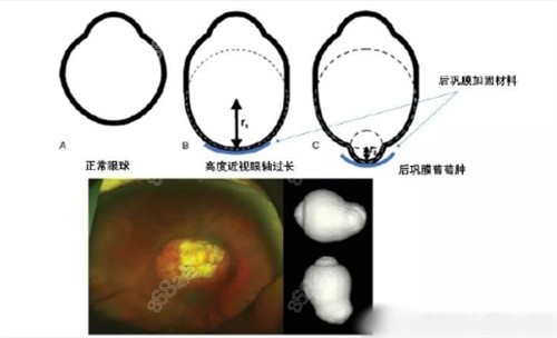 后巩膜加固术度数还涨吗