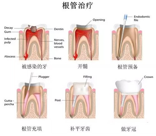 根管治疗流程