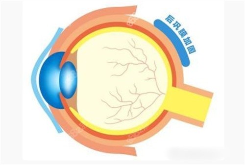 后巩膜加固术度数还涨吗