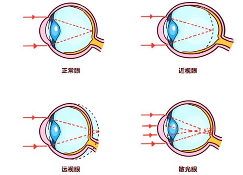 不同眼球状态成像示意图