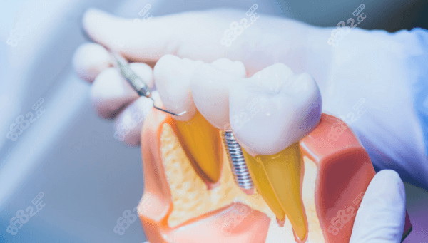南宁岭南口腔种植牙收费标准