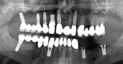 多颗牙种植术后照片