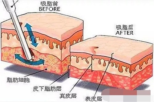 吸脂前后脂肪对比图