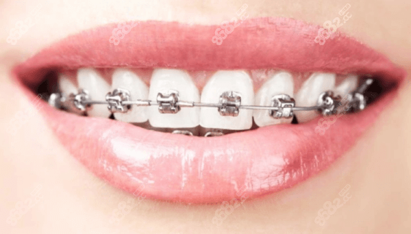 南宁岭南口腔牙齿矫正收费标准