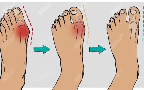國(guó)內(nèi)拇外翻醫(yī)生排名前十