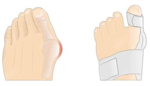 國(guó)內(nèi)拇外翻醫(yī)生排名前十