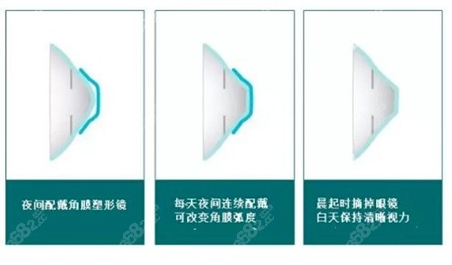 角膜塑形镜的原理