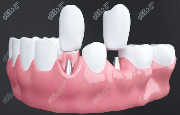 無錫美奧口腔種植牙價格