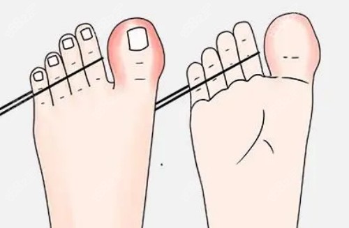 國(guó)內(nèi)拇外翻醫(yī)生排名前十