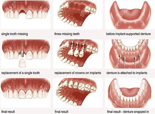 缺失牙进行种植