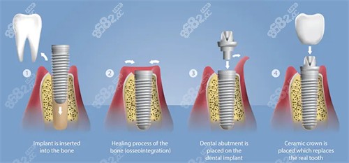种植牙手术流程图