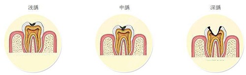 不同牙齿龋坏照片