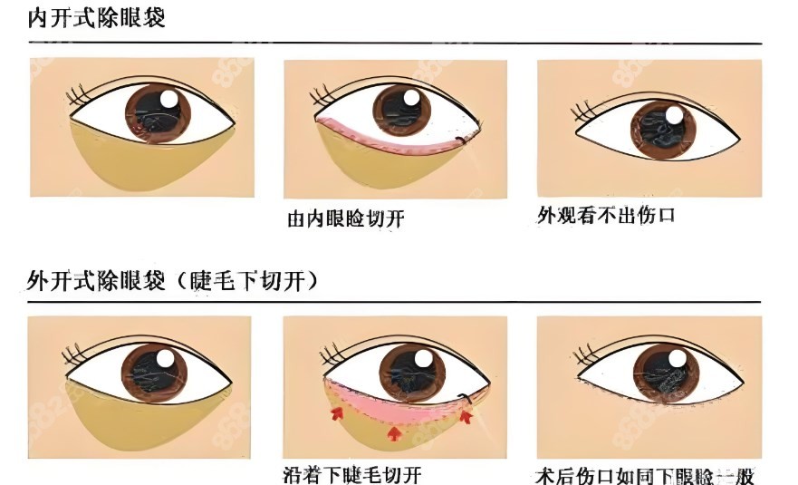 深圳地区做眼袋手术方式