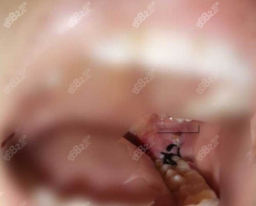 拔牙伤口缝合照片