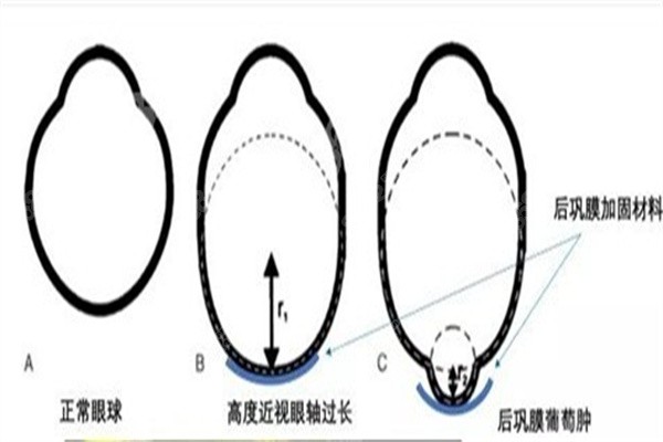 王乐今后巩膜家加固术价格