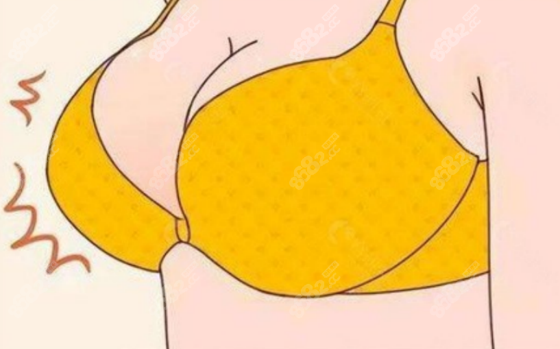 自体脂肪丰胸