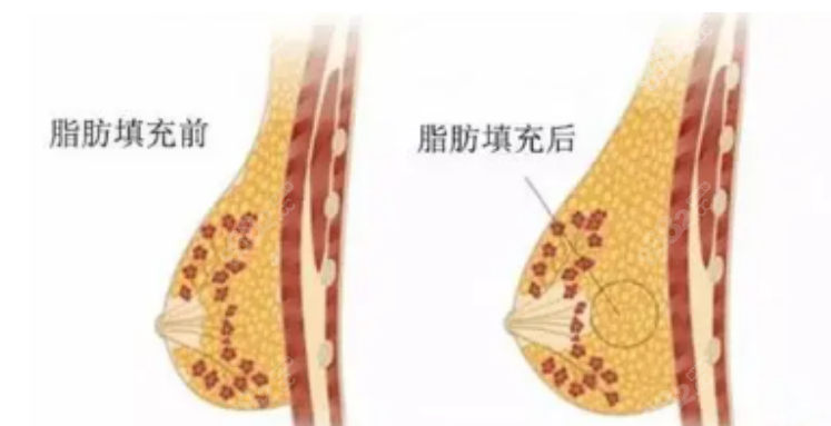 项力源医生脂肪填充