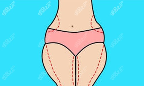 大腿吸脂手术设计方案示意图