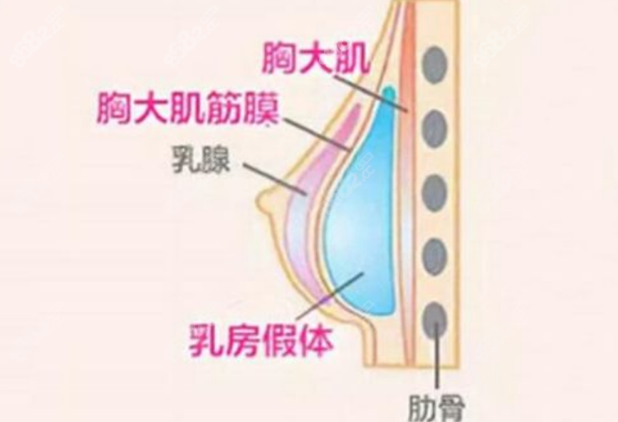 自体脂肪丰胸
