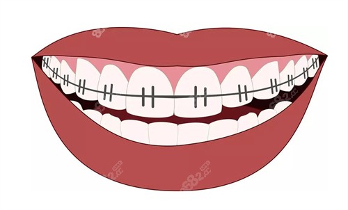 牙齿矫正矫正牙齿不整齐