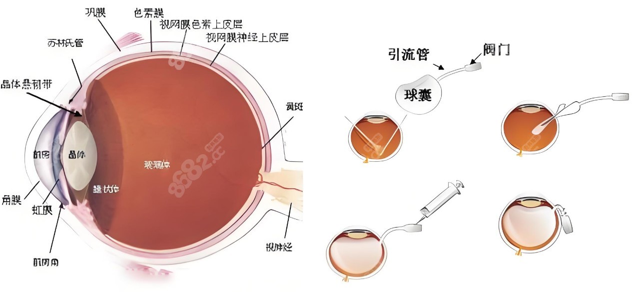 人工玻璃体球囊植入术后的疗效好