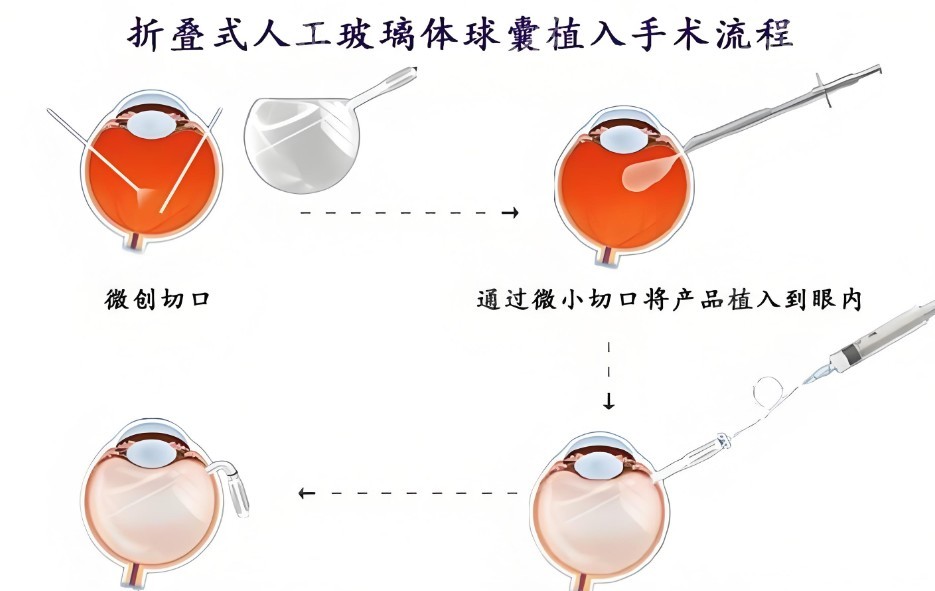 人工玻璃体球囊植入术的费用在1万-6万起