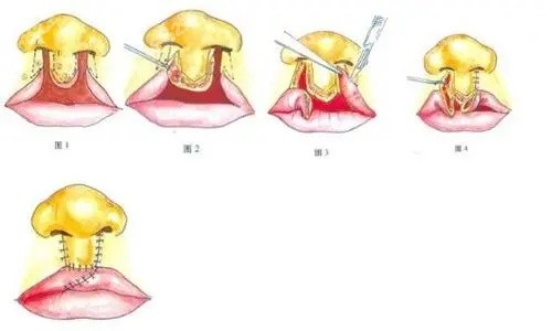 唇裂鼻修復(fù)圖.jpg