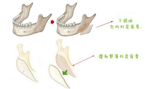 下颌角皮质骨截骨手术图片