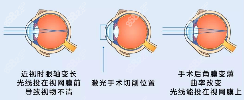 上海黑馬眼科醫(yī)院近視激光手術(shù)m.66ub.cn