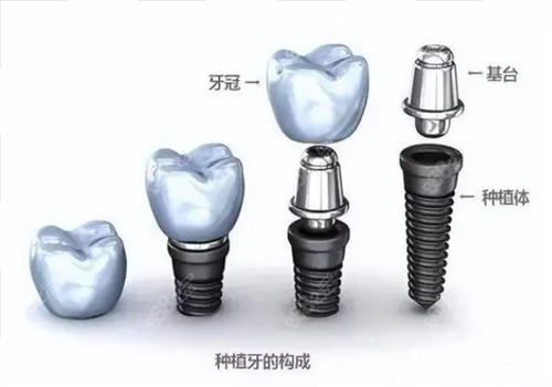 韩国登腾和意大利bb种植体哪个好