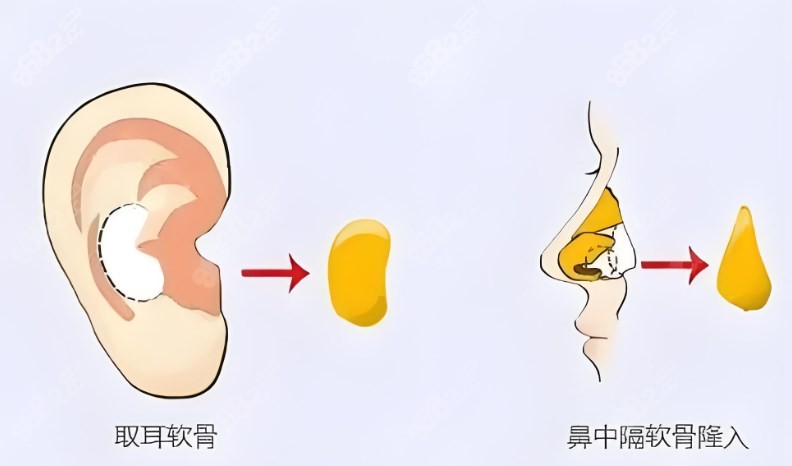 重庆军科范文亮做鼻子