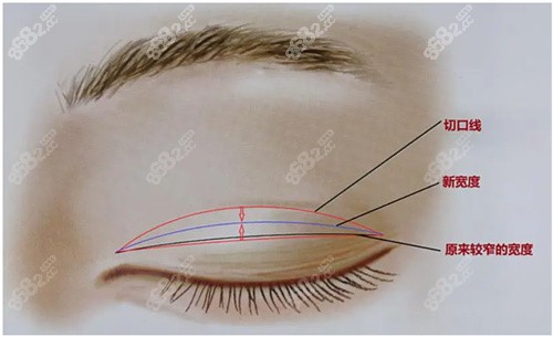 割双眼皮后肉条眼修复原理图示