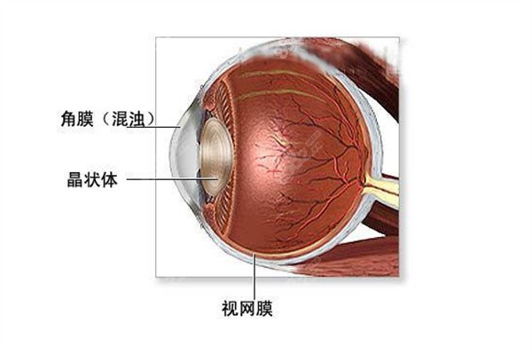 爱尔眼科角膜移植怎么样