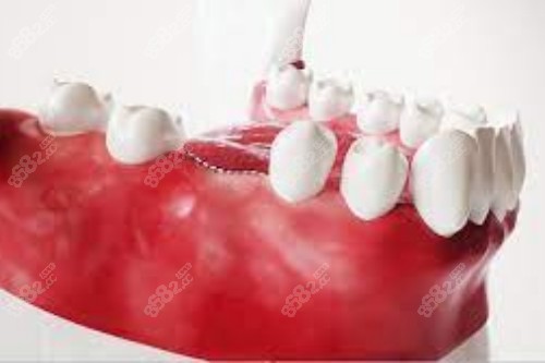 合肥新安口腔种植牙模型
