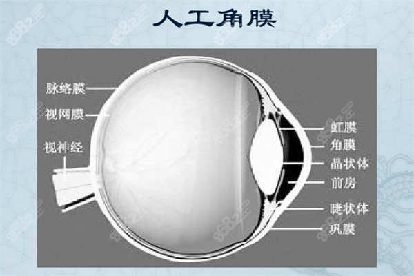 爱尔眼科人工角膜