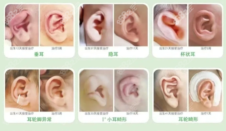 广州高尚做耳再造、耳整形技术好