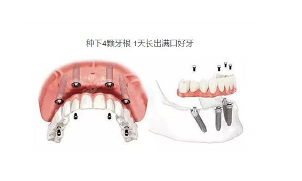 上海第六人民医院牙科种植牙费用