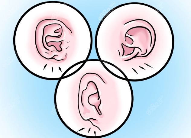 耳再造手术的长期疗效