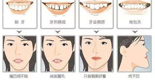 牙齿矫正脸型的变化图