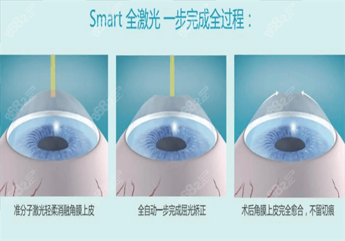 近视手术有哪些方式？